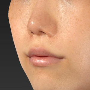 新宿ラクル美容外科クリニック　山本厚志　「人中短縮術（リップリフト）＋口角挙上（スマイルリップ）」　手術後１２ヶ月目　８月２６日