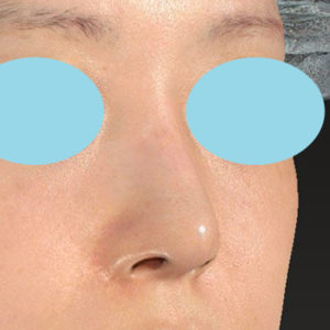 「鼻孔縁下降術」　新宿ラクル美容外科クリニック　山本厚志　２０代女性　手術後３ヶ月目　５月２２日