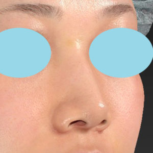 新宿ラクル美容外科クリニック　山本厚志　「小鼻縮小+α法」　手術後６ヶ月目　７月１０日