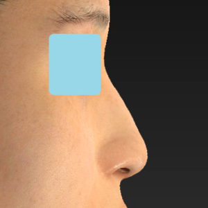 「鼻孔縁下降術」　新宿ラクル美容外科クリニック　山本厚志　２０代女性　手術後１２ヶ月目　９月２１日