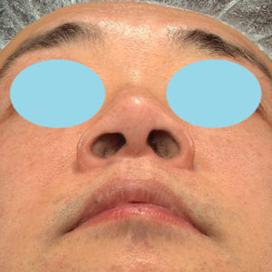 新宿ラクル美容外科クリニック　山本厚志　「小鼻縮小+α法」　手術前　４月１２日