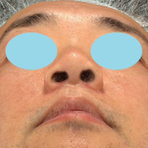 新宿ラクル美容外科クリニック　山本厚志　「小鼻縮小+α法」　手術後１ヶ月目　４月１２日