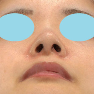 新宿ラクル美容外科クリニック　山本厚志　「小鼻縮小+α法」　手術後３ヶ月目　４月２２日