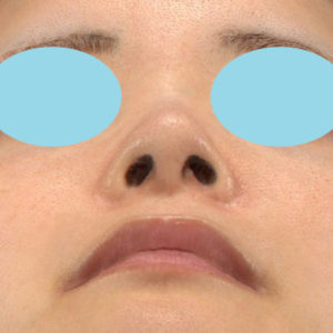 新宿ラクル美容外科クリニック　山本厚志　「小鼻縮小+α法」　手術後６ヶ月目　８月４日