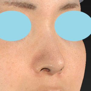 新宿ラクル美容外科クリニック　山本厚志　「小鼻縮小+α法」　手術後６ヶ月目　８月４日