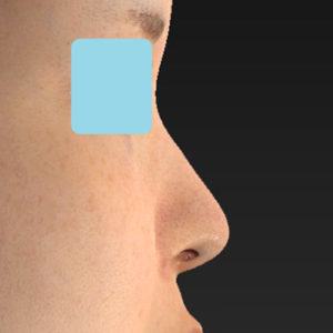 新宿ラクル美容外科クリニック　山本厚志　「小鼻縮小+α法」　手術後６ヶ月目　８月４日