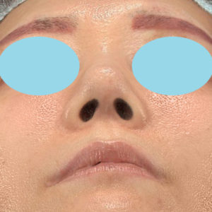 「耳介軟骨移植＋鼻尖形成＋猫手術＋貴族手術」　新宿ラクル美容外科クリニック　２０代女性　手術後１２ヶ月目　７月２０日