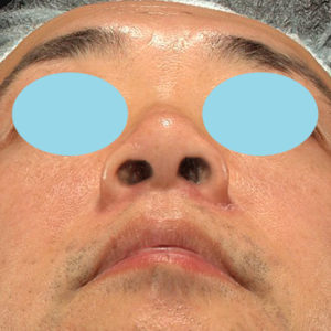 新宿ラクル美容外科クリニック　山本厚志　「小鼻縮小+α法」　手術後３ヶ月目　６月１２日