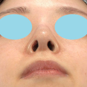「鼻孔縁下降術」　新宿ラクル美容外科クリニック　山本厚志　２０代女性　手術後６ヶ月目　７月２日