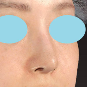 「鼻孔縁下降術」　新宿ラクル美容外科クリニック　山本厚志　２０代女性　手術後６ヶ月目　７月２日
