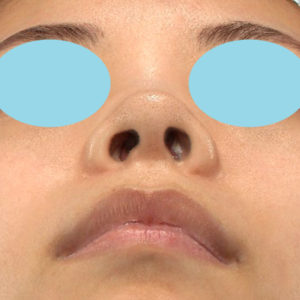 「小鼻縮小+α＋鼻尖縮小（close法）」　新宿ラクル美容外科クリニック　２０代女性　手術前　６月２６日