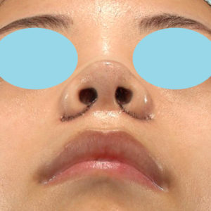 「小鼻縮小+α＋鼻尖縮小（close法）」　新宿ラクル美容外科クリニック　２０代女性　手術直後　６月２６日