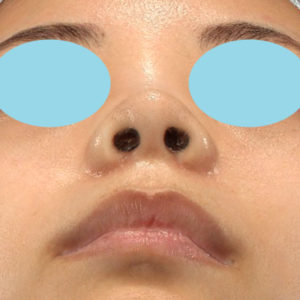 「小鼻縮小+α＋鼻尖縮小（close法）」　新宿ラクル美容外科クリニック　２０代女性　手術後１ヶ月目　６月２６日