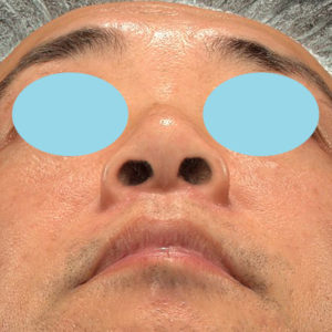 新宿ラクル美容外科クリニック　山本厚志　「小鼻縮小+α法」　手術後６ヶ月目　９月１３日