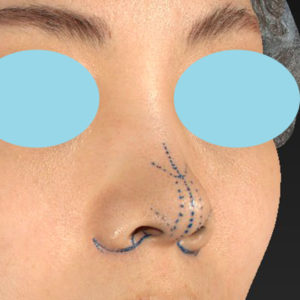 「小鼻縮小+α＋鼻尖縮小（close法）」　新宿ラクル美容外科クリニック　２０代女性　デザイン　６月２６日
