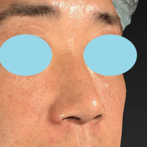 新宿ラクル美容外科クリニック　山本厚志　「小鼻縮小+α法」　手術後６ヶ月目　９月１３日