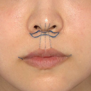 新宿ラクル美容外科クリニック　山本厚志　「人中短縮術（リップリフト）＋口角挙上（スマイルリップ）」　デザイン　７月３０日