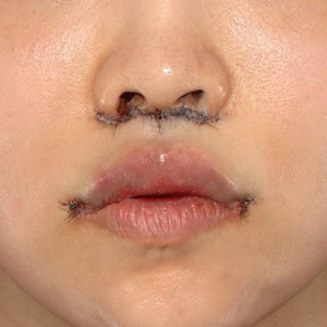 新宿ラクル美容外科クリニック　山本厚志　「人中短縮術（リップリフト）＋口角挙上（スマイルリップ）」　手術直後　７月３０日