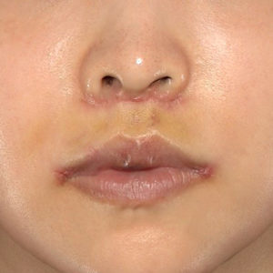 新宿ラクル美容外科クリニック　山本厚志　「人中短縮術（リップリフト）＋口角挙上（スマイルリップ）」　手術後１週間目　７月３０日