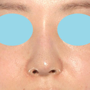 「鼻孔縁下降術」　新宿ラクル美容外科クリニック　山本厚志　２０代女性　手術後１２ヶ月目　６月１８日