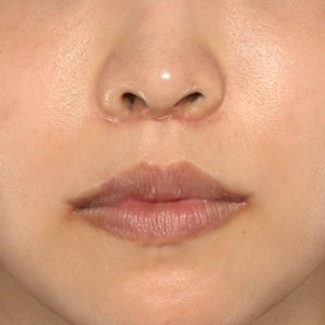 新宿ラクル美容外科クリニック　山本厚志　「人中短縮術（リップリフト）＋口角挙上（スマイルリップ）」　手術後１ヶ月目　７月３０日