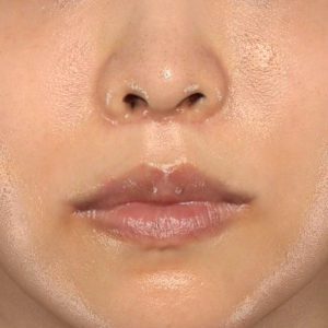 新宿ラクル美容外科クリニック　山本厚志　「人中短縮術（リップリフト）＋口角挙上（スマイルリップ）」　手術後２ヶ月目　７月３０日