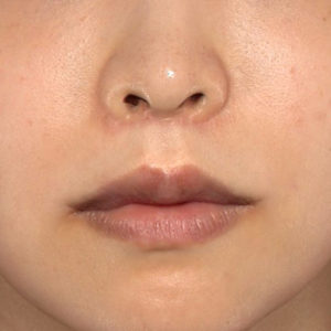 新宿ラクル美容外科クリニック　山本厚志　「人中短縮術（リップリフト）＋口角挙上（スマイルリップ）」　手術後３ヶ月目　８月１９日