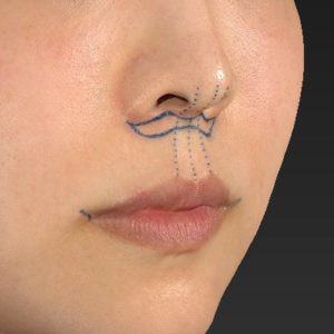 新宿ラクル美容外科クリニック　山本厚志　「人中短縮術（リップリフト）＋口角挙上（スマイルリップ）」　デザイン　７月３０日