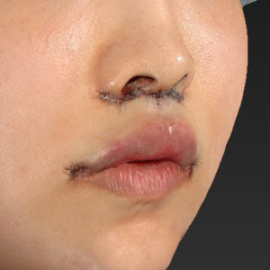 新宿ラクル美容外科クリニック　山本厚志　「人中短縮術（リップリフト）＋口角挙上（スマイルリップ）」　手術直後　７月３０日