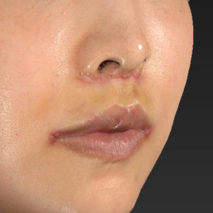新宿ラクル美容外科クリニック　山本厚志　「人中短縮術（リップリフト）＋口角挙上（スマイルリップ）」　手術後１週間目　７月３０日