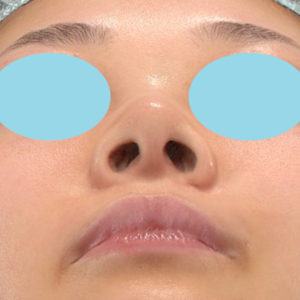 新宿ラクル美容外科クリニック　山本厚志　「小鼻縮小+α法」　手術後１２ヶ月目　１２月２２日