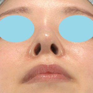 「鼻孔縁下降術」　新宿ラクル美容外科クリニック　山本厚志　２０代女性　手術後１２ヶ月目　６月１８日