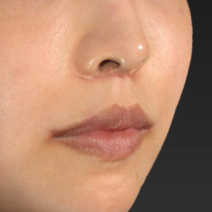 新宿ラクル美容外科クリニック　山本厚志　「人中短縮術（リップリフト）＋口角挙上（スマイルリップ）」　手術後１ヶ月目　７月３０日