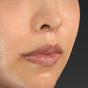 新宿ラクル美容外科クリニック　山本厚志　「人中短縮術（リップリフト）＋口角挙上（スマイルリップ）」　手術後２ヶ月目　７月３０日