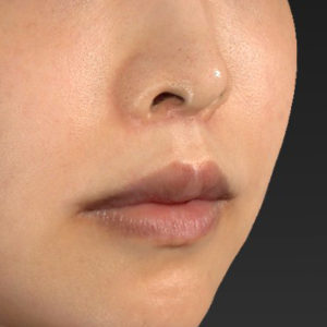 新宿ラクル美容外科クリニック　山本厚志　「人中短縮術（リップリフト）＋口角挙上（スマイルリップ）」　手術後３ヶ月目　８月１９日