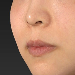 新宿ラクル美容外科クリニック　山本厚志　「人中短縮術（リップリフト）＋口角挙上（スマイルリップ）」　手術前　７月３０日