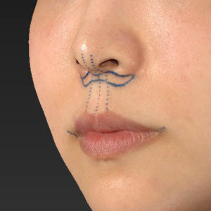 デザイン 新宿ラクル美容外科クリニック 山本厚志 「人中短縮術(リップリフト)+口角挙上(スマイルリップ)」 デザイン 7月30日