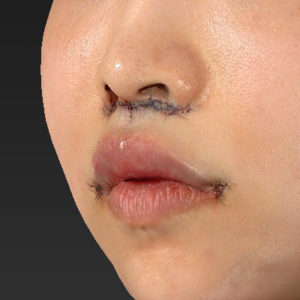 新宿ラクル美容外科クリニック　山本厚志　「人中短縮術（リップリフト）＋口角挙上（スマイルリップ）」　手術直後　７月３０日