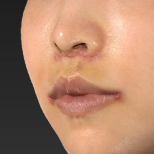 新宿ラクル美容外科クリニック　山本厚志　「人中短縮術（リップリフト）＋口角挙上（スマイルリップ）」　手術後１週間目　７月３０日