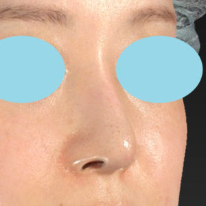 「鼻孔縁下降術」　新宿ラクル美容外科クリニック　山本厚志　２０代女性　手術後１２ヶ月目　６月１８日