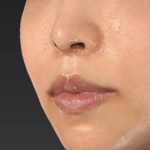 新宿ラクル美容外科クリニック　山本厚志　「人中短縮術（リップリフト）＋口角挙上（スマイルリップ）」　手術後２ヶ月目　７月３０日