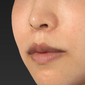 新宿ラクル美容外科クリニック　山本厚志　「人中短縮術（リップリフト）＋口角挙上（スマイルリップ）」　手術後３ヶ月目　８月１９日