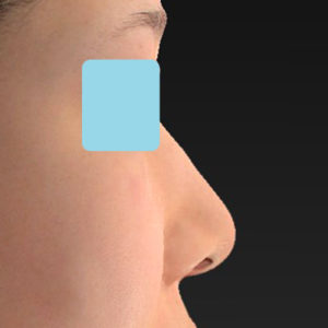 新宿ラクル美容外科クリニック　山本厚志　「小鼻縮小+α法」　手術後１２ヶ月目　１２月２２日