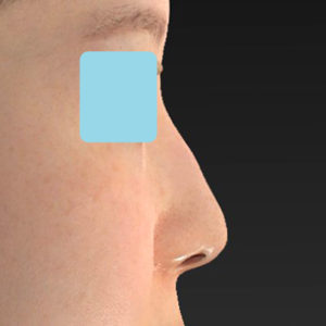 「鼻孔縁下降術」　新宿ラクル美容外科クリニック　山本厚志　２０代女性　手術後１２ヶ月目　６月１８日