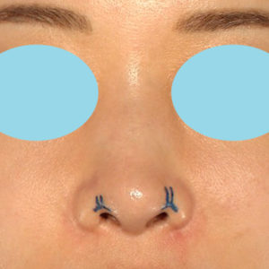 新宿ラクル美容外科クリニック　山本厚志　「鼻孔縁下降術」　デザイン　８月５日