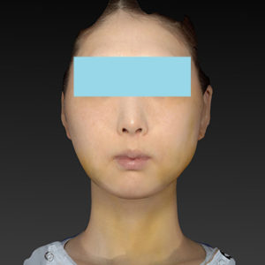 新宿ラクル美容外科クリニック　山本厚志　ナチュラルフェイスリフト　手術後１週間目　８月２０日