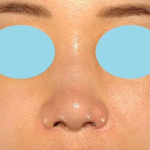 新宿ラクル美容外科クリニック　山本厚志　「鼻孔縁下降術」　手術後１ヶ月目　８月５日