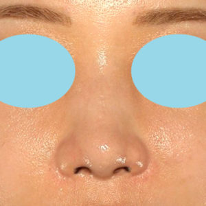 新宿ラクル美容外科クリニック　山本厚志　「鼻孔縁下降術」　手術後２ヶ月目　８月５日