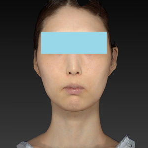 新宿ラクル美容外科クリニック　山本厚志　ナチュラルフェイスリフト　手術後２ヶ月目　８月２０日