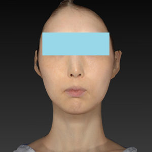 新宿ラクル美容外科クリニック　山本厚志　ナチュラルフェイスリフト　手術後６ヶ月目　１１月１１日